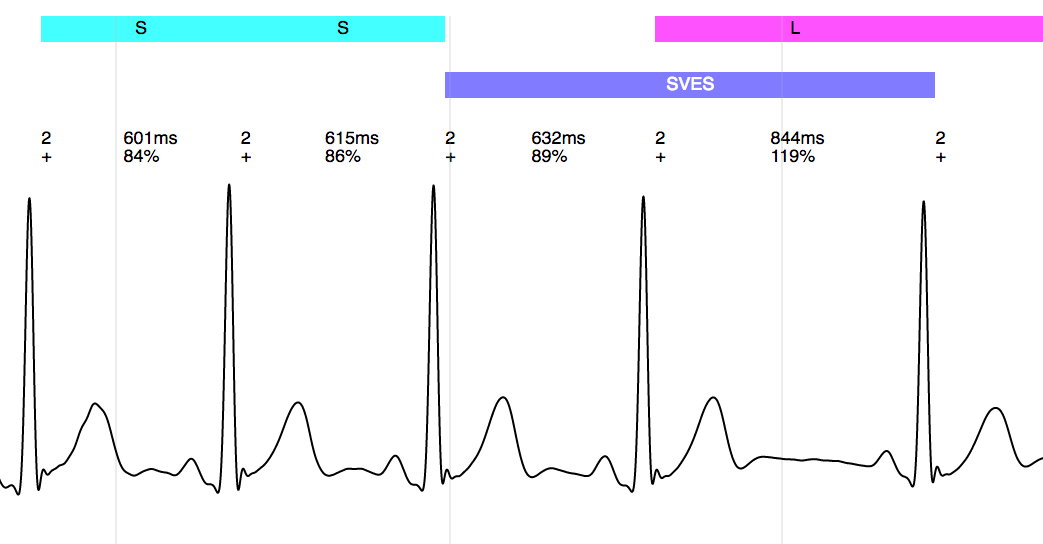 signal with SVES